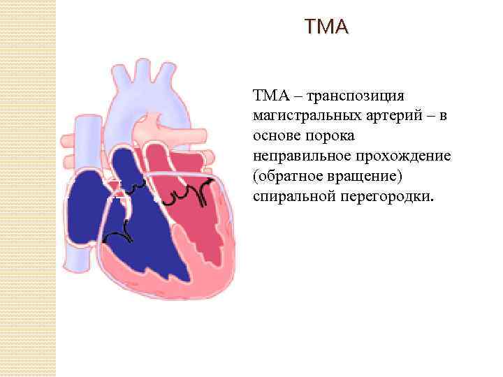 ТМА – транспозиция магистральных артерий – в основе порока неправильное прохождение (обратное вращение) спиральной