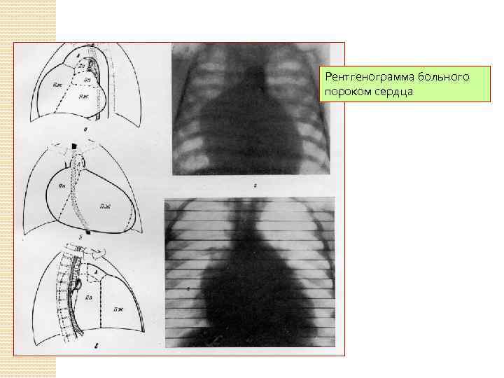 Рентгенограмма больного пороком сердца 