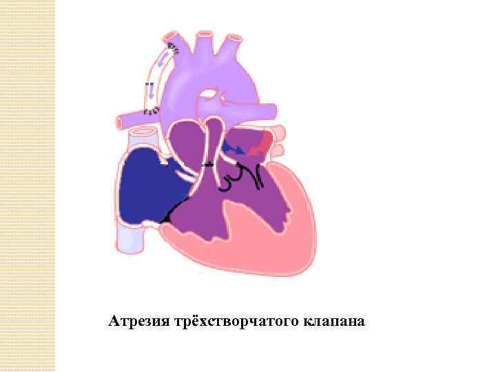 Атрезия трёхстворчатого клапана 