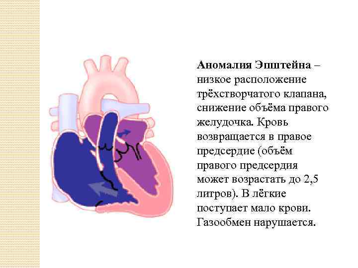 Аномалия Эпштейна – низкое расположение трёхстворчатого клапана, снижение объёма правого желудочка. Кровь возвращается в