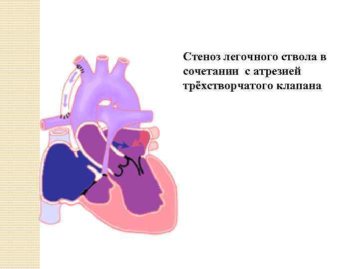 Атрезия трехстворчатого клапана презентация