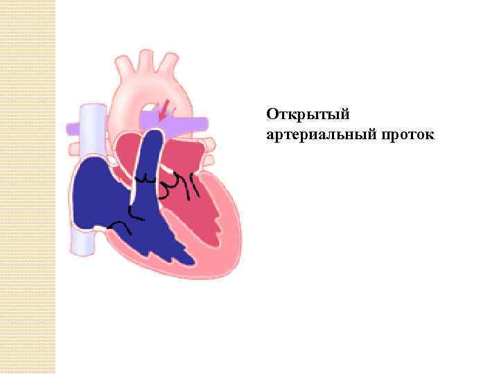 Открытый артериальный проток 
