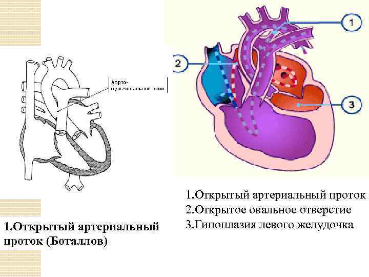 1. Открытый артериальный проток (Боталлов) 1. Открытый артериальный проток 2. Открытое овальное отверстие 3.