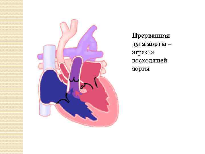 Прерванная дуга аорты – атрезия восходящей аорты 