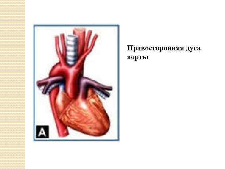 Правосторонняя дуга аорты 