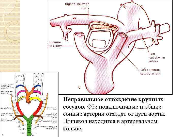 Неправильное отхождение крупных сосудов. Обе подключичные и общие сонные артерии отходят от дуги аорты.