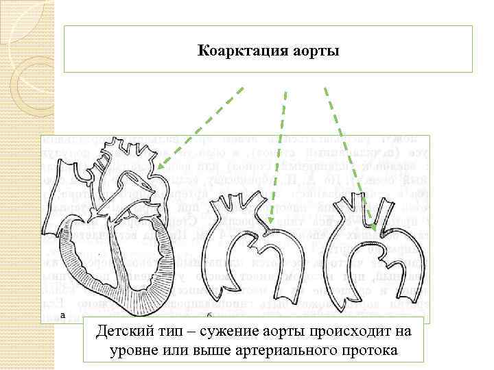 Коарктация аорты Детский тип – сужение аорты происходит на уровне или выше артериального протока