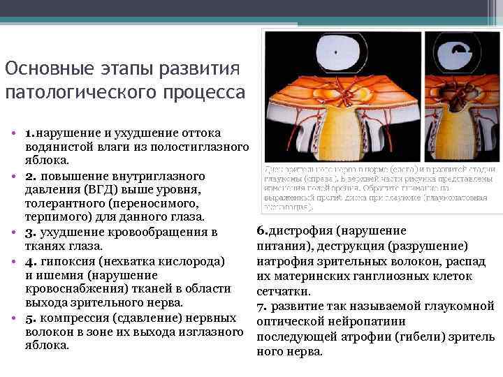 Основные этапы развития патологического процесса • 1. нарушение и ухудшение оттока водянистой влаги из
