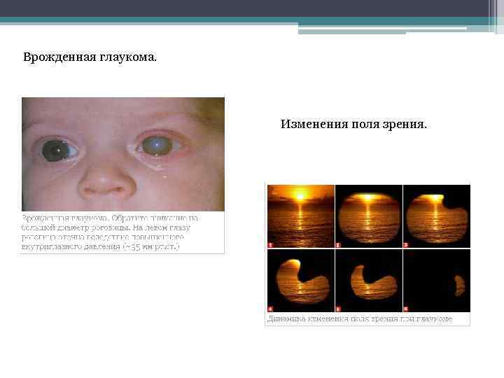 Врожденная глаукома. Изменения поля зрения. 