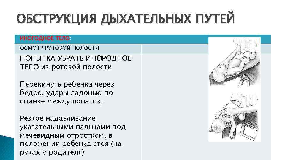 ОБСТРУКЦИЯ ДЫХАТЕЛЬНЫХ ПУТЕЙ ИНОГОДНОЕ ТЕЛО: ОСМОТР РОТОВОЙ ПОЛОСТИ ПОПЫТКА УБРАТЬ ИНОРОДНОЕ ТЕЛО из ротовой