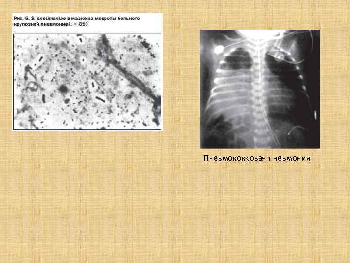 Пневмококковая пневмония 