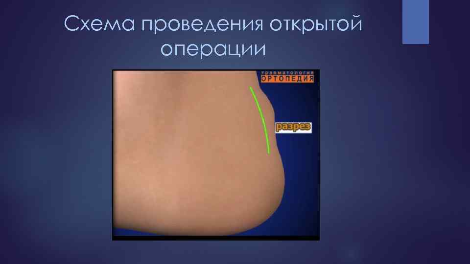 Схема проведения открытой операции 