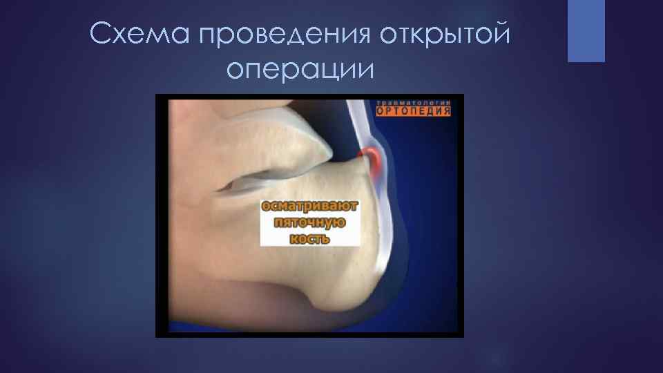 Схема проведения открытой операции 