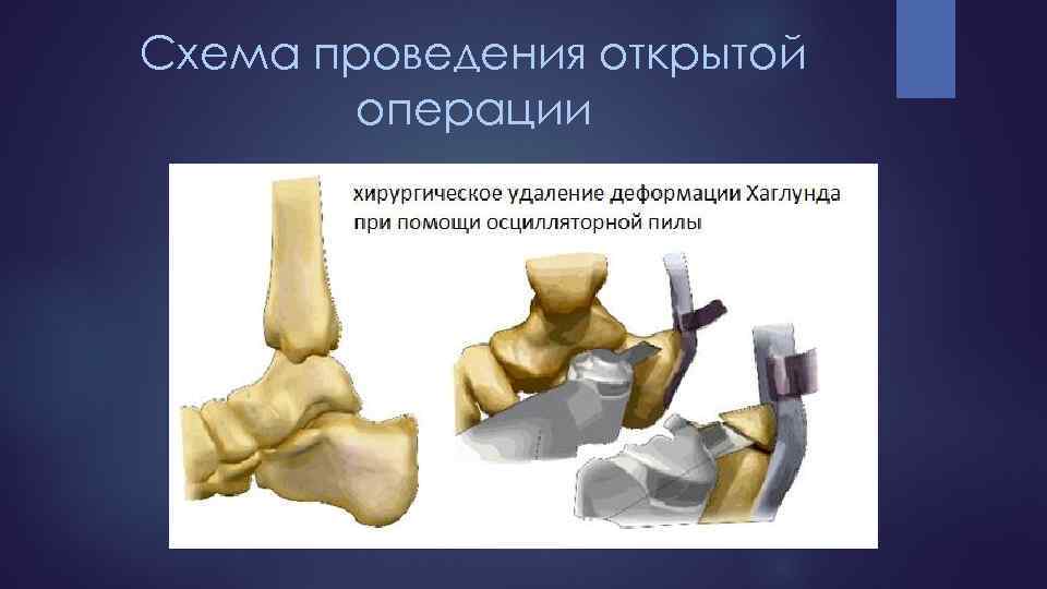 Схема проведения открытой операции 
