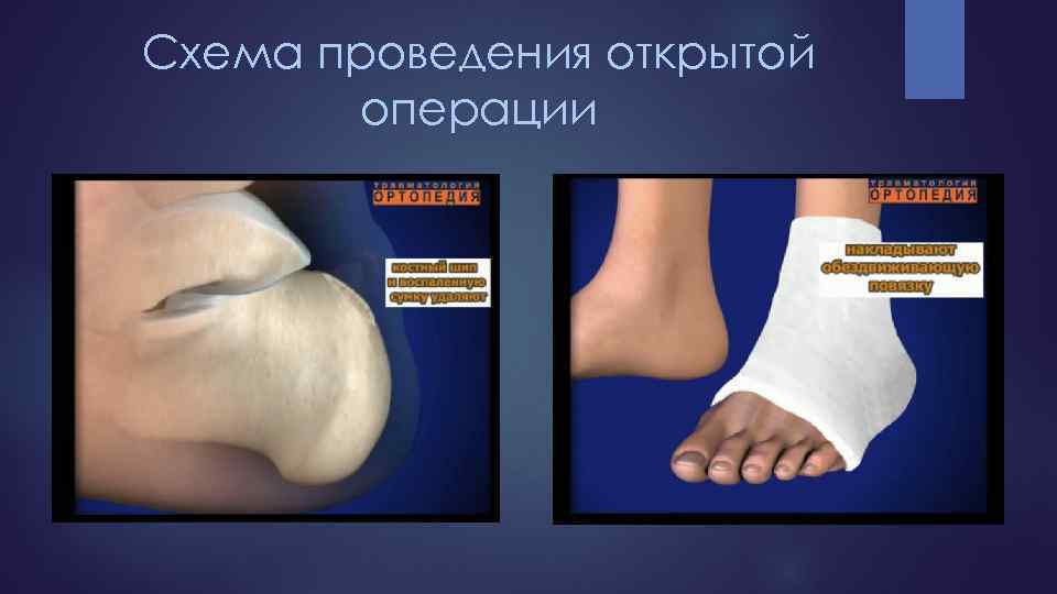 Схема проведения открытой операции 