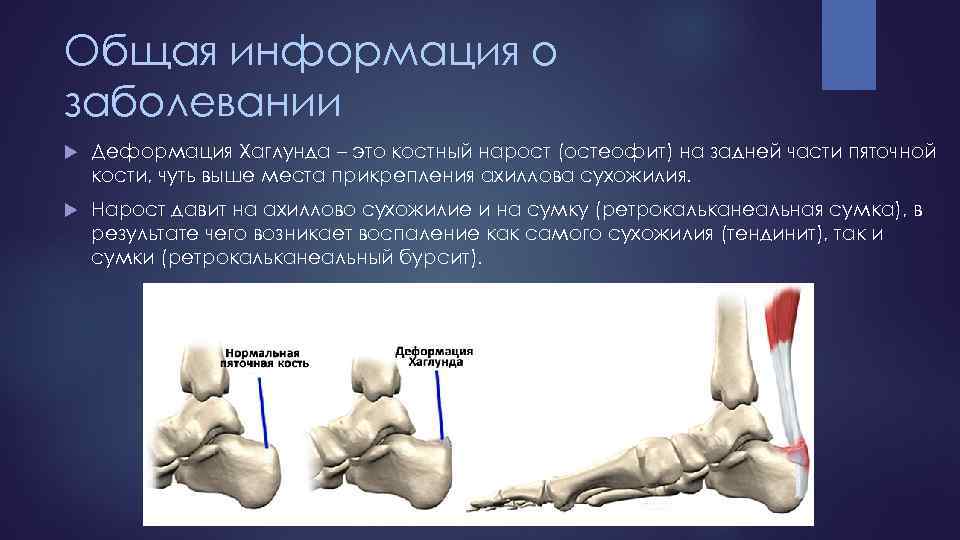 Общая информация о заболевании Деформация Хаглунда – это костный нарост (остеофит) на задней части