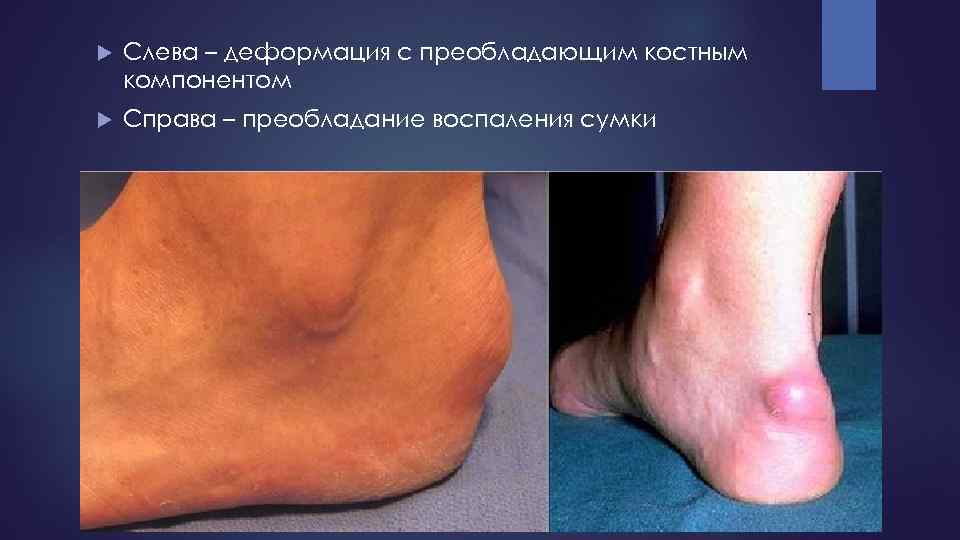  Слева – деформация с преобладающим костным компонентом Справа – преобладание воспаления сумки 