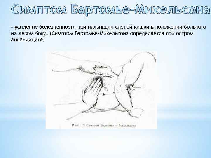 Симптом Бартомье-Михельсона - усиление болезненности при пальпации слепой кишки в положении больного на левом