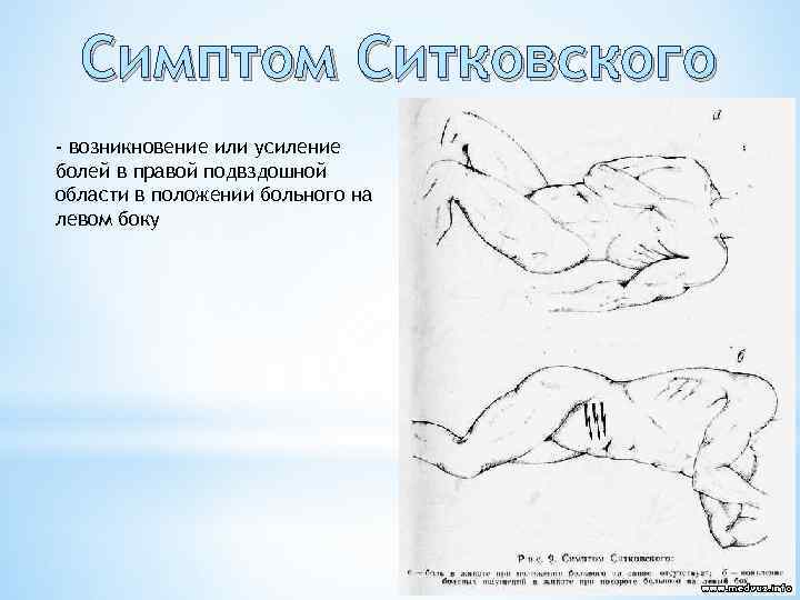 Симптом Ситковского - возникновение или усиление болей в правой подвздошной области в положении больного