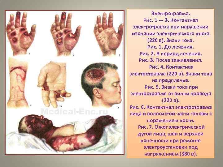 Электротравма. Рис. 1 — 3. Контактная электротравма при нарушении изоляции электрического утюга (220 в).