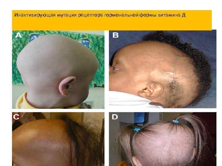 Инактивирующая мутация рецептора гормональной формы витамина Д 