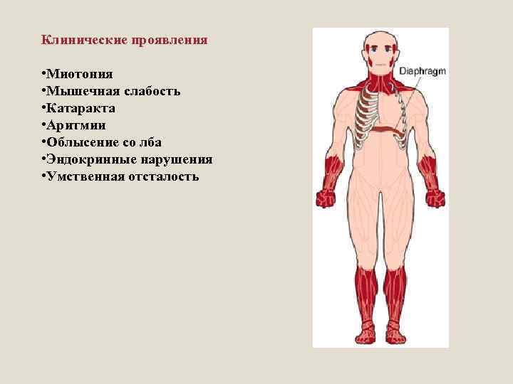 Клинические проявления • Миотония • Мышечная слабость • Катаракта • Аритмии • Облысение со