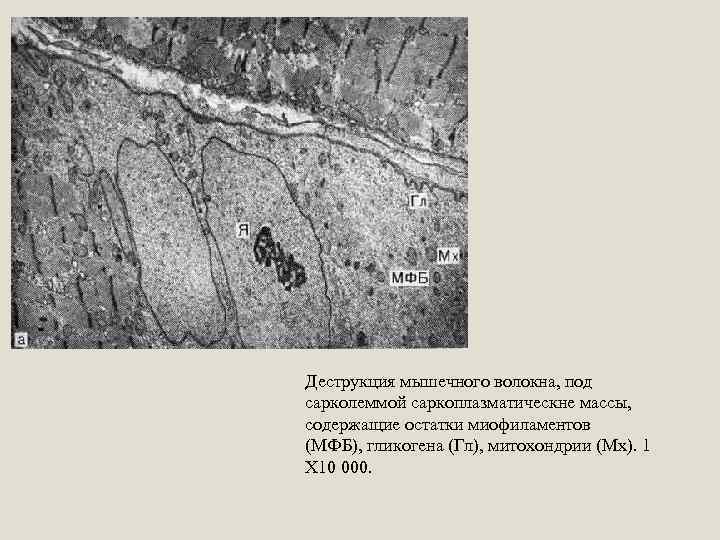 Деструкция мышечного волокна, под сарколеммой саркоплазматическне массы, содержащие остатки миофиламентов (МФБ), гликогена (Гл), митохондрии