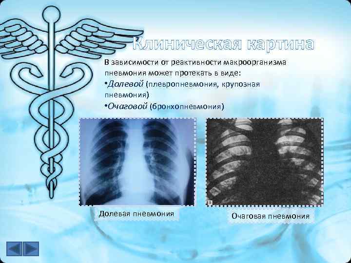 Клиническая картина В зависимости от реактивности макроорганизма пневмония может протекать в виде: • Долевой