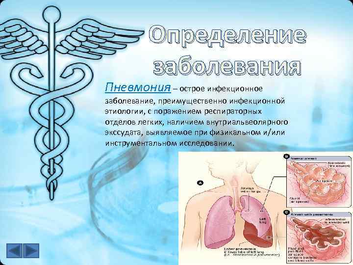 Определение заболевания Пневмония – острое инфекционное заболевание, преимущественно инфекционной этиологии, с поражением респираторных отделов