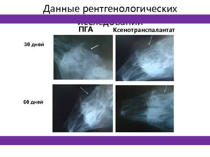 Данные рентгенологических исследований ПГА 30 дней 60 дней Ксенотранспалантат 