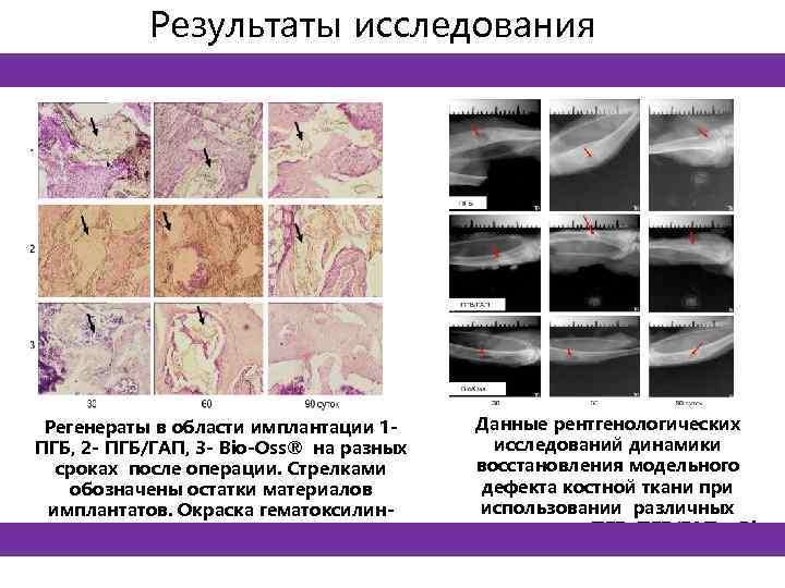 Результаты исследования Регенераты в области имплантации 1 ПГБ, 2 - ПГБ/ГАП, 3 - Bio-Oss®