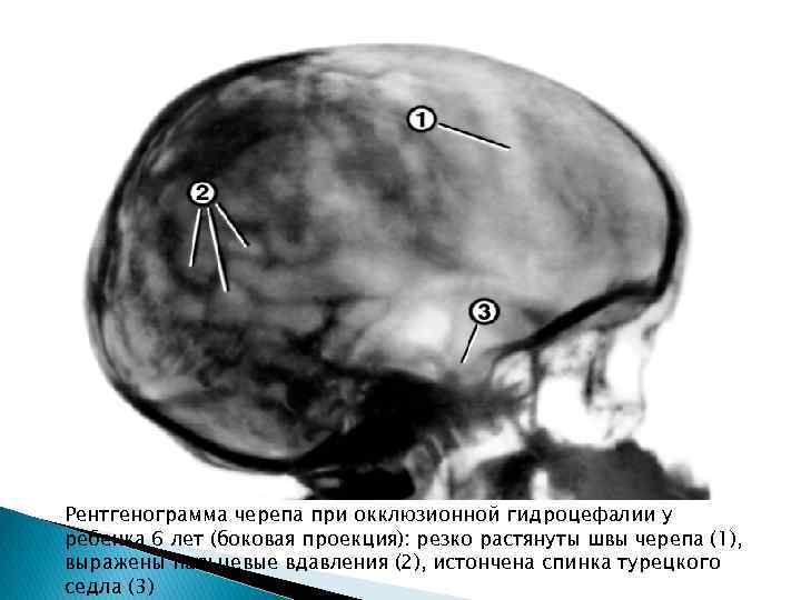 Рентгенограмма черепа при окклюзионной гидроцефалии у ребенка 6 лет (боковая проекция): резко растянуты швы