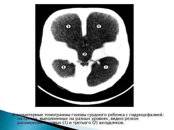 Компьютерные томограммы головы грудного ребенка с гидроцефалией: на срезах, выполненных на разных уровнях, видно