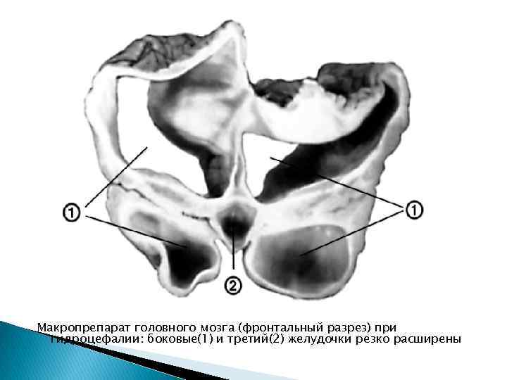 Макропрепарат головного мозга (фронтальный разрез) при гидроцефалии: боковые(1) и третий(2) желудочки резко расширены 
