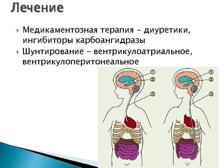 Лечение Медикаментозная терапия – диуретики, ингибиторы карбоангидразы Шунтирование – вентрикулоатриальное, вентрикулоперитонеальное 