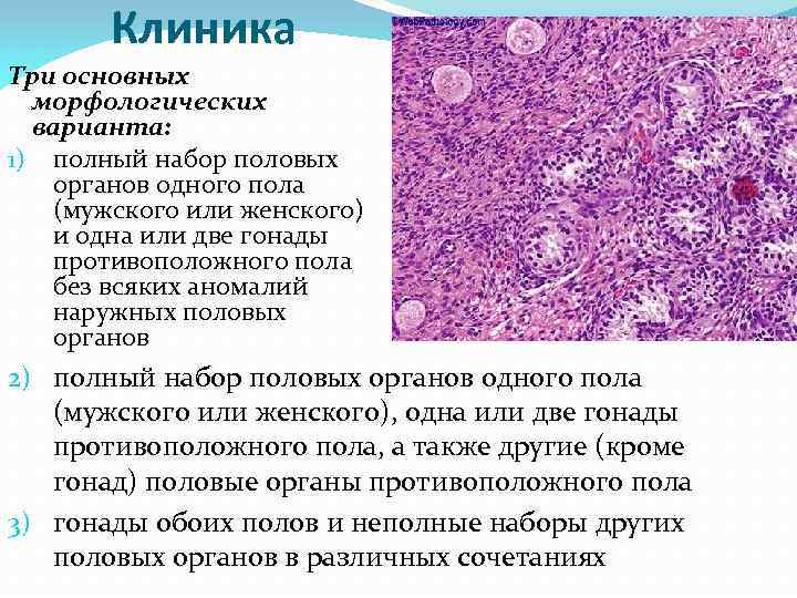 Клиника Три основных морфологических варианта: 1) полный набор половых органов одного пола (мужского или