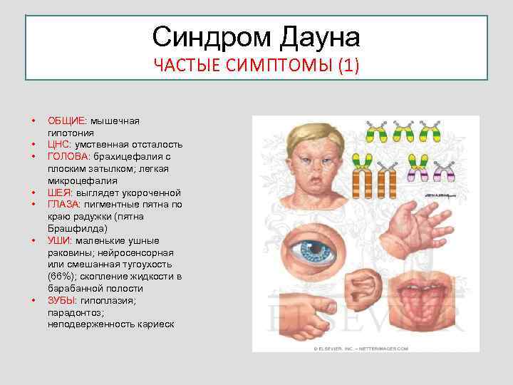 Синдром Дауна ЧАСТЫЕ СИМПТОМЫ (1) • • ОБЩИЕ: мышечная гипотония ЦНС: умственная отсталость ГОЛОВА: