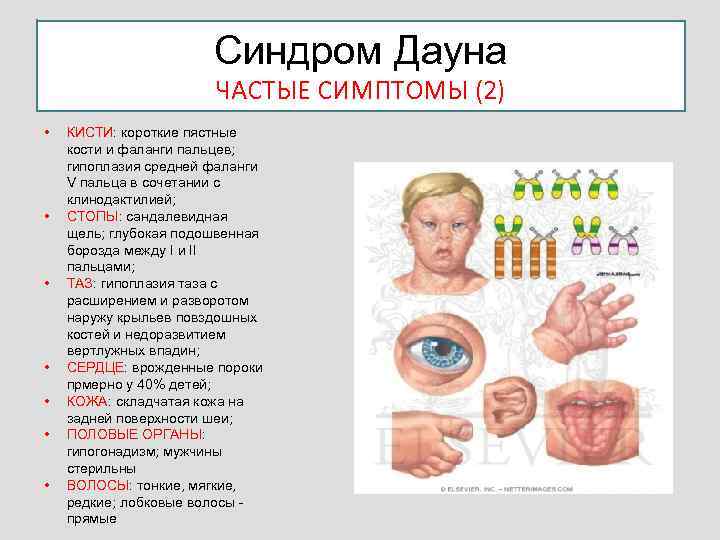 Синдром Дауна ЧАСТЫЕ СИМПТОМЫ (2) • • КИСТИ: короткие пястные кости и фаланги пальцев;