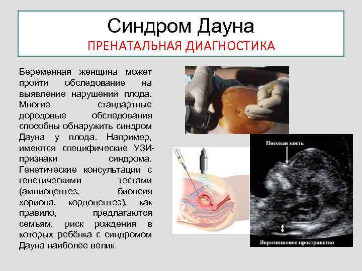 Синдром Дауна ПРЕНАТАЛЬНАЯ ДИАГНОСТИКА Беременная женщина может пройти обследование на выявление нарушений плода. Многие