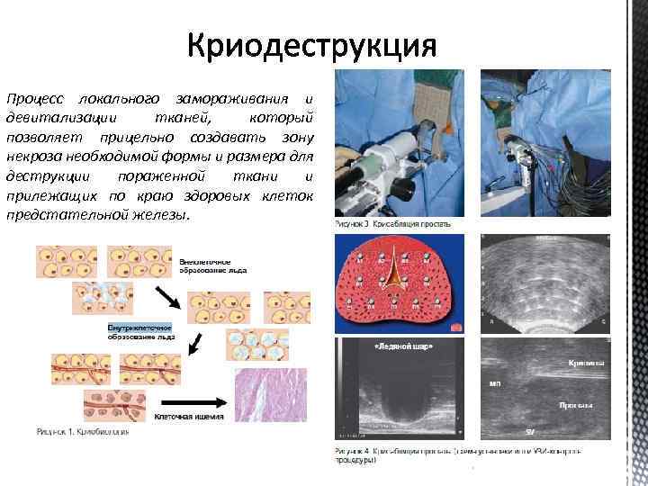 Процесс локального замораживания и девитализации тканей, который позволяет прицельно создавать зону некроза необходимой формы