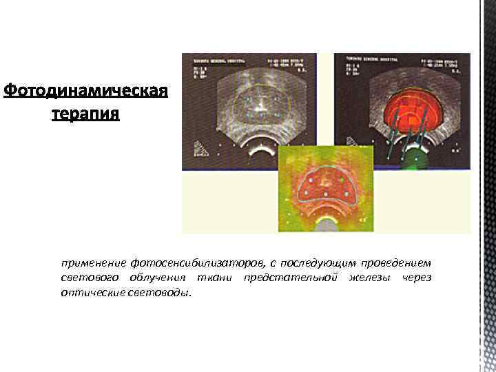 применение фотосенсибилизаторов, с последующим проведением светового облучения ткани предстательной железы через оптические световоды. 