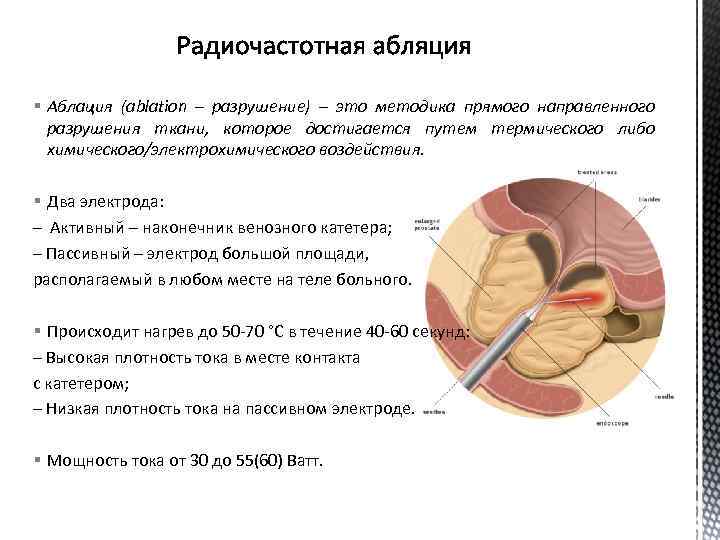 § Аблация (ablation – разрушение) – это методика прямого направленного разрушения ткани, которое достигается