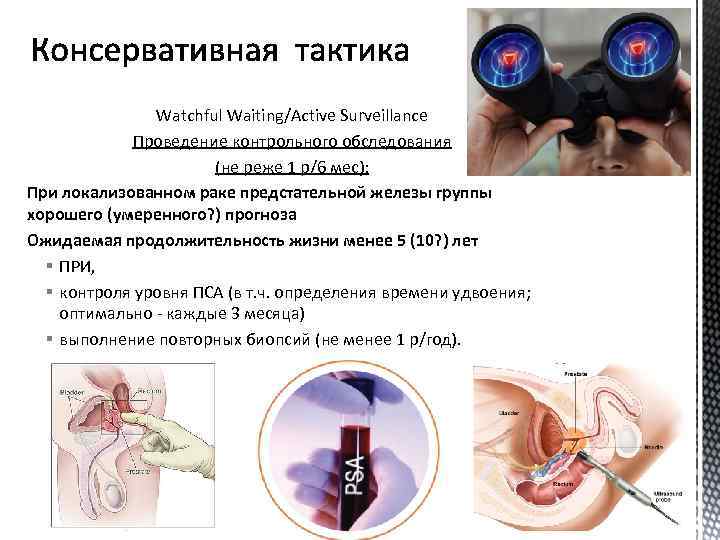 Watchful Waiting/Active Surveillance Проведение контрольного обследования (не реже 1 р/6 мес): При локализованном раке