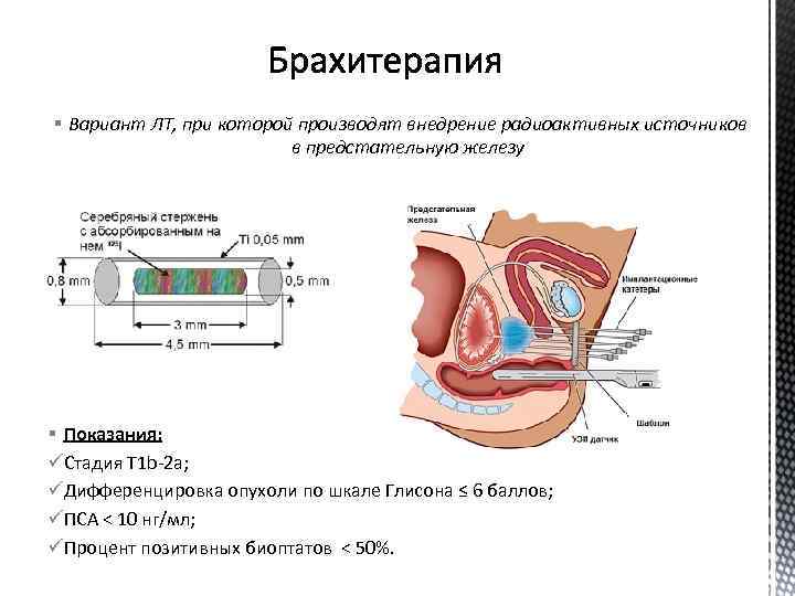 § Вариант ЛТ, при которой производят внедрение радиоактивных источников в предстательную железу § Показания: