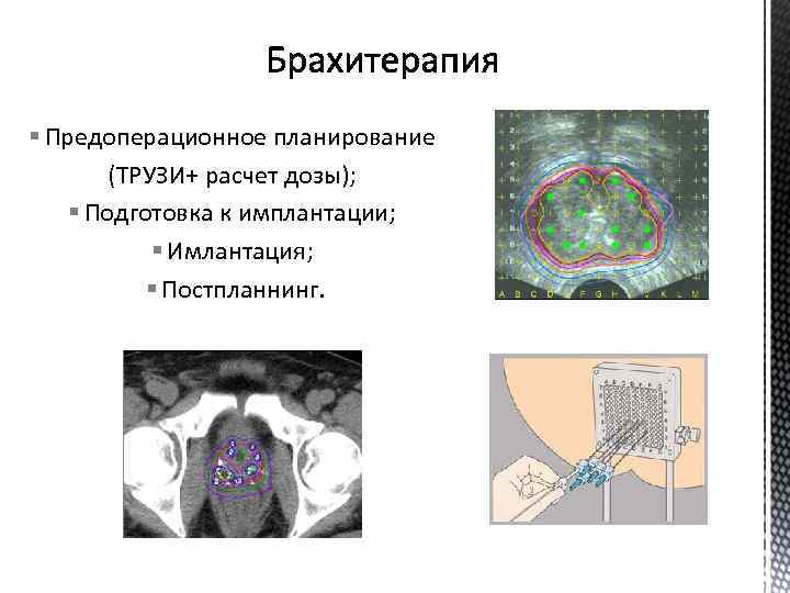 § Предоперационное планирование (ТРУЗИ+ расчет дозы); § Подготовка к имплантации; § Имлантация; § Постпланнинг.