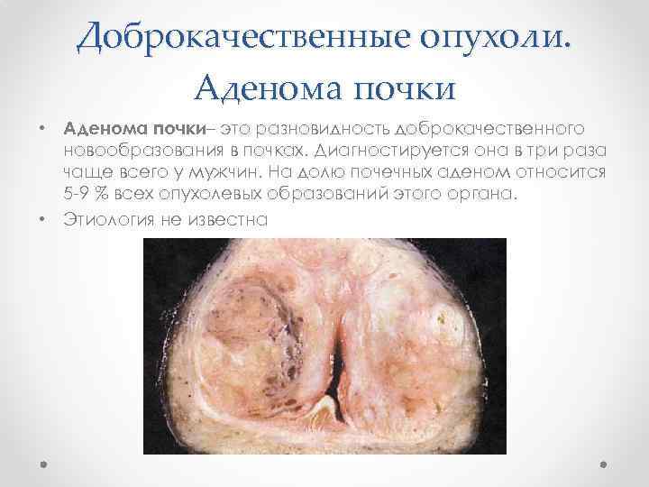 Доброкачественные опухоли. Аденома почки • Аденома почки– это разновидность доброкачественного новообразования в почках. Диагностируется