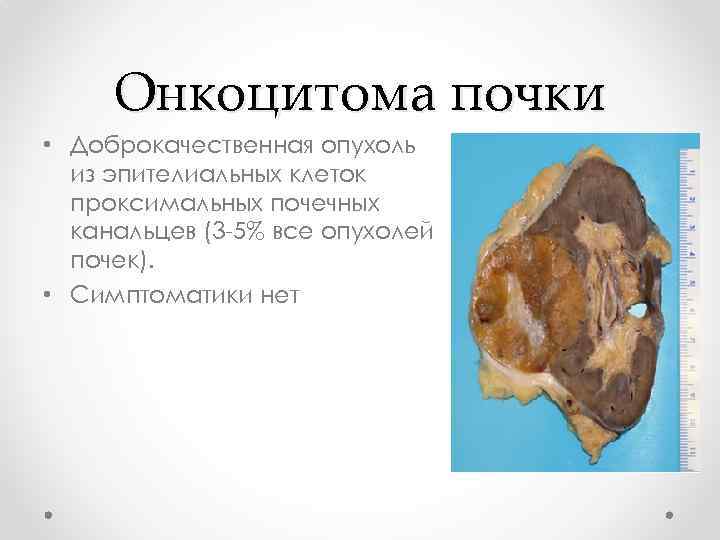Онкоцитома почки • Доброкачественная опухоль из эпителиальных клеток проксимальных почечных канальцев (3 -5% все