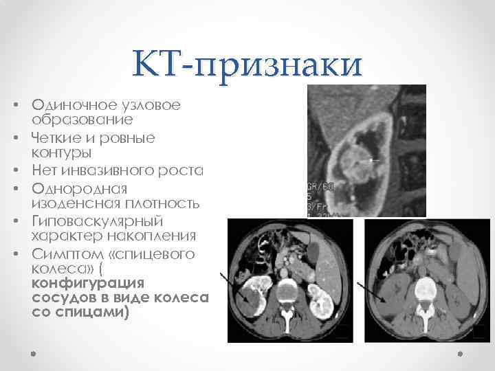 КТ-признаки • Одиночное узловое образование • Четкие и ровные контуры • Нет инвазивного роста