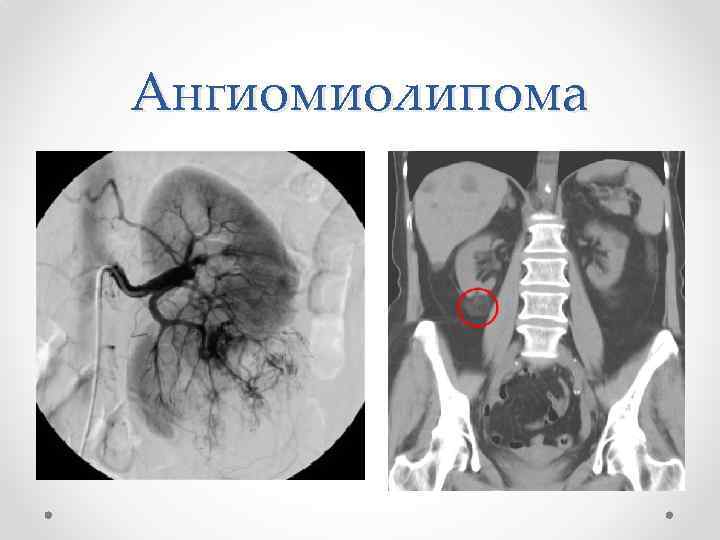 Ангиомиолипома 