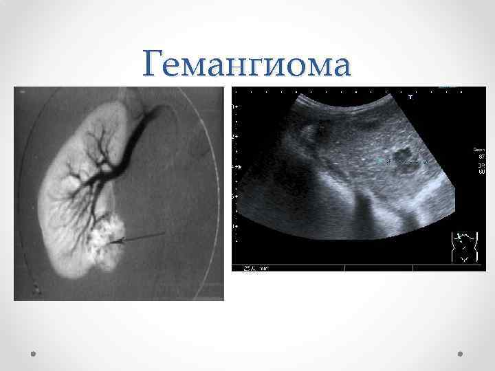 Гемангиома 